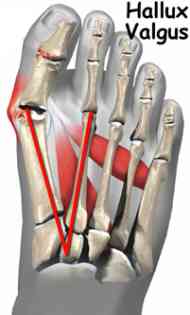 Hallux valgus